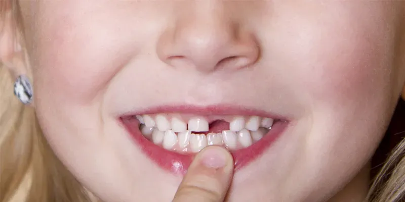 Nằm Mơ Thấy Nhổ Răng Đánh Số Mấy? Nằm Mơ Thấy Nhổ Răng Đánh Số Mấy?