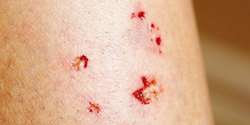 Mơ thấy bị chó cắn và con số may mắn Mơ thấy bị chó cắn và con số may mắn