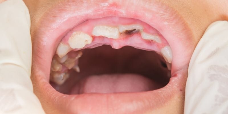 Mơ thấy rụng răng xử lý thế nào Mơ thấy rụng răng xử lý thế nào