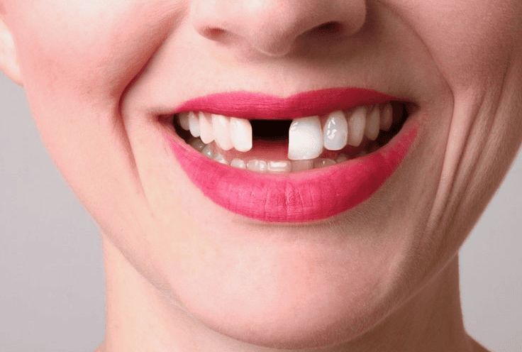 Giải Mã Giấc Mơ Rụng Răng Cửa Theo Góc Nhìn 188BET