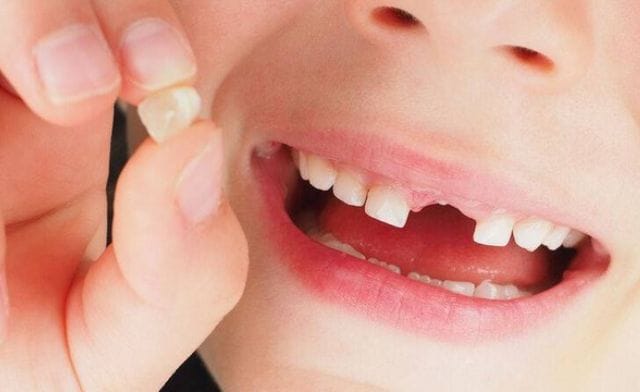 Cách đối phó với việc mộng gãy răng không chảy máu