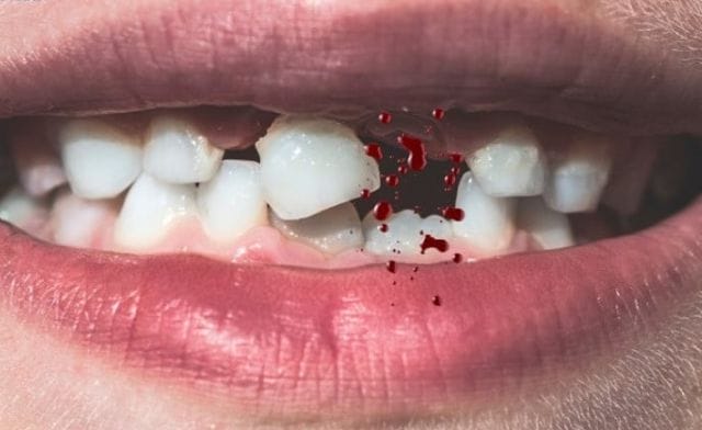 Chi tiết ý nghĩa giấc mơ thấy gãy răng chảy máu theo từng bối cảnh