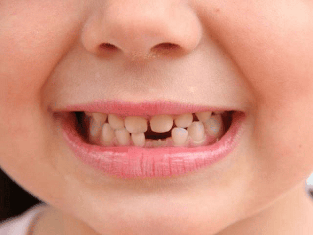 Chiêm bao rụng 2 chiếc răng ở hàm dưới