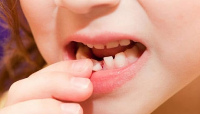 Chiêm bao rụng răng hàm dưới bị chảy máu