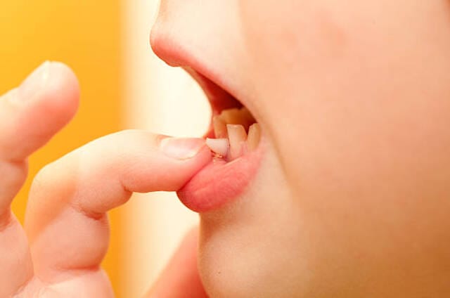 Điềm báo ở đây cho thấy những điều xui xẻo bất ngờ khi răng hàm dứoi bị gãy