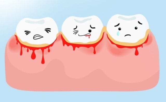 Khám phá ngay thông điểm ẩn sâu giấc chiêm bao thấy chảy máu răng