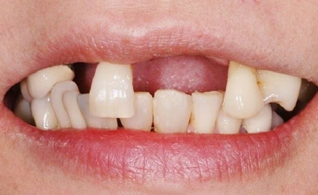 Mơ rụng răng không chảy máu dưới góc nhìn tâm lý và khoa học là gì?