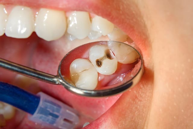 Mơ thấy đang điều trị một chiếc răng sâu