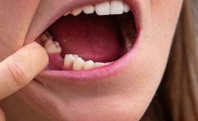 Mỗi một giấc mơ rụng răng nhưng lại không chảy máu sẽ mang ý nghĩa khác nhau