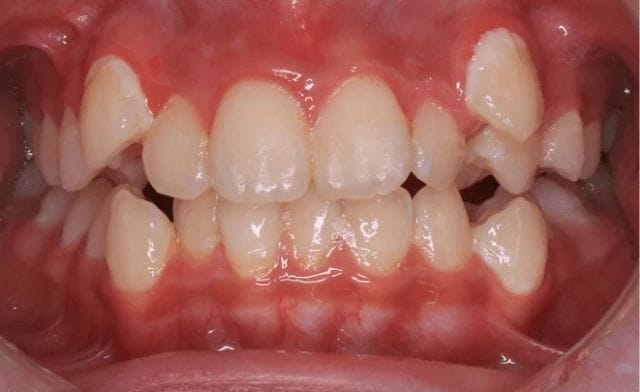 Thấy mọc răng trong mơ nên đánh con số nào?