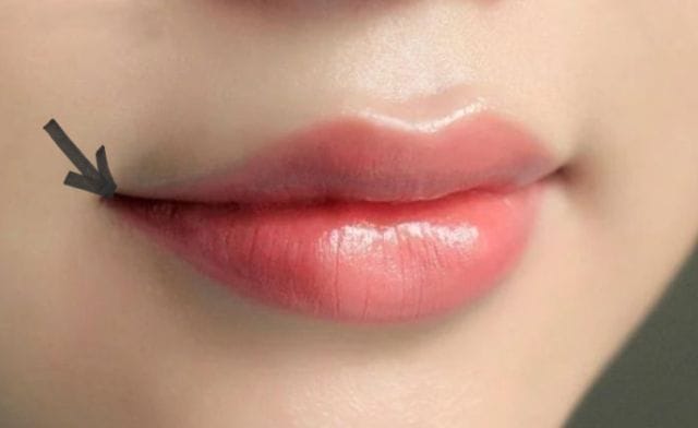 Theo góc độ khoa học, mép miệng bị giật do nguyên nhân nào?