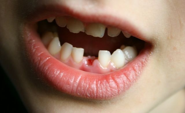Ý nghĩa giấc mộng thấy gãy răng cửa chi tiết theo từng bối cảnh Ý nghĩa giấc mộng thấy gãy răng cửa chi tiết theo từng bối cảnh