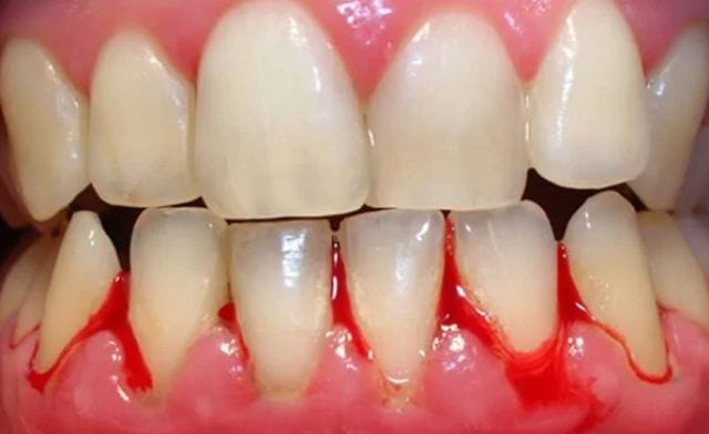 Ý nghĩa thực sự của giấc mơ chảy máu răng là gì?